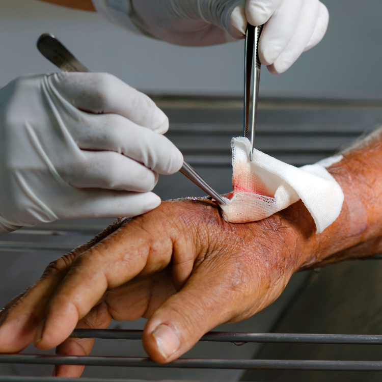 Clinician providing wound care related to surgical & post-operative wounds